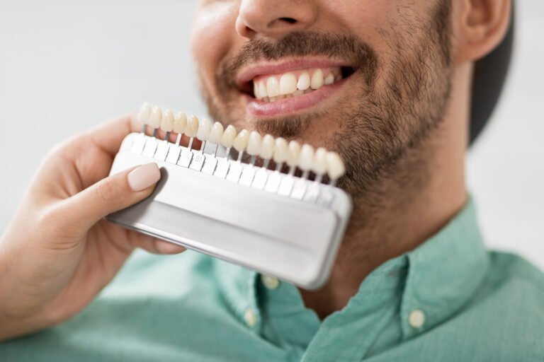 Carillas dentales en Alcobendas: cómo conseguir una sonrisa natural